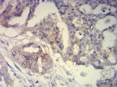 Figure 6:Immunohistochemical analysis of paraffin-embedded ovarian cancer tissues using CD239 mouse mAb with DAB staining.