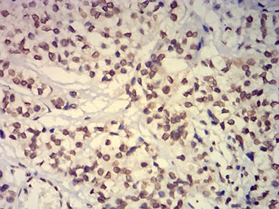 Figure 7:Immunohistochemical analysis of paraffin-embedded bladder cancer tissues using EHMT2 mouse mAb with DAB staining.