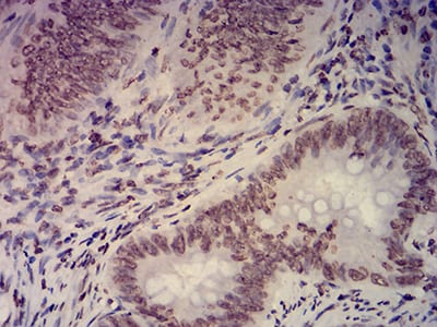 Figure 8:Immunohistochemical analysis of paraffin-embedded rectum cancer tissues using EHMT2 mouse mAb with DAB staining.