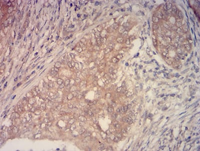 Figure 6:Immunohistochemical analysis of paraffin-embedded cervical cancer tissues using KMT2C mouse mAb with DAB staining.