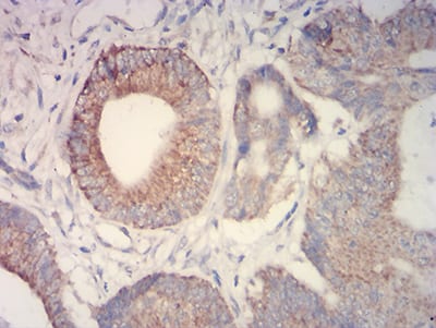 Figure 4:Immunohistochemical analysis of paraffin-embedded colon cancer tissues using IDH2 mouse mAb with DAB staining.