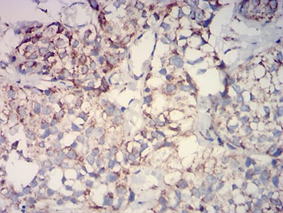 Figure 5:Immunohistochemical analysis of paraffin-embedded bladder cancer tissues using IDH2 mouse mAb with DAB staining.