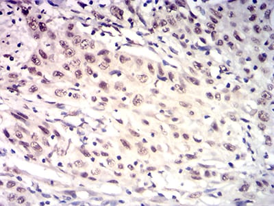 Figure 6:Immunohistochemical analysis of paraffin-embedded esophageal cancer tissues using HTRA2 mouse mAb with DAB staining.