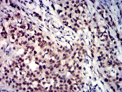 Figure 7:Immunohistochemical analysis of paraffin-embedded bladder cancer tissues using TBP mouse mAb with DAB staining.