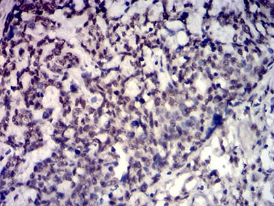Figure 8:Immunohistochemical analysis of paraffin-embedded esophageal cancer tissues using TBP mouse mAb with DAB staining.