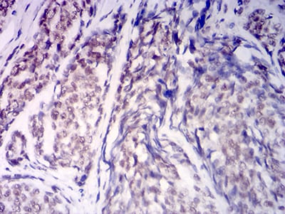 Figure 7:Immunohistochemical analysis of paraffin-embedded esophageal cancer tissues using KDM1A mouse mAb with DAB staining.