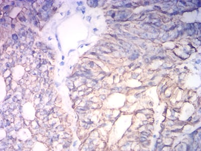 Figure 6:Immunohistochemical analysis of paraffin-embedded colon cancer tissues using KRT19 mouse mAb with DAB staining.