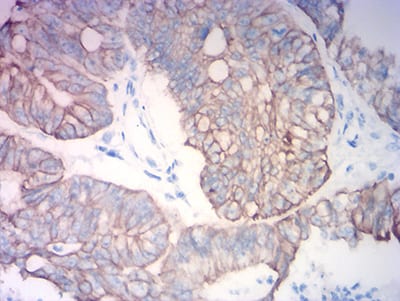 Figure 5:Immunohistochemical analysis of paraffin-embedded colon cancer tissues using KRT19 mouse mAb with DAB staining.