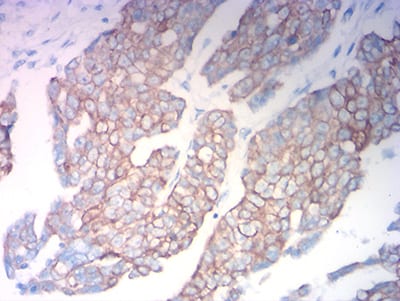 Figure 7:Immunohistochemical analysis of paraffin-embedded ovarian cancer tissues using KRT18 mouse mAb with DAB staining.