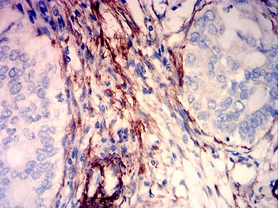 Figure 6:Immunohistochemical analysis of paraffin-embedded cervical cancer tissues using CALD1 mouse mAb with DAB staining.