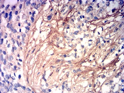 Figure 5:Immunohistochemical analysis of paraffin-embedded cervical cancer tissues using COL3A1 mouse mAb with DAB staining.