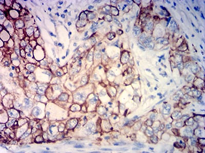 Figure 7:Immunohistochemical analysis of paraffin-embedded lung cancer tissues using KRT18 mouse mAb with DAB staining.