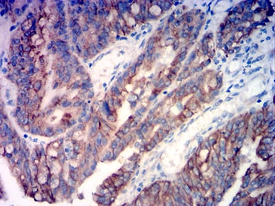 Figure 8:Immunohistochemical analysis of paraffin-embedded rectum cancer tissues using KRT18 mouse mAb with DAB staining.