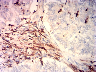 Figure 5:Immunohistochemical analysis of paraffin-embedded cervical cancer tissues using CD14 mouse mAb with DAB staining.