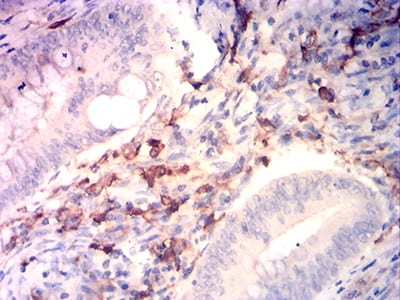 Figure 6:Immunohistochemical analysis of paraffin-embedded rectum cancer tissues using CD14 mouse mAb with DAB staining.