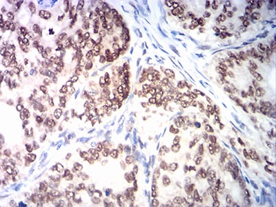 Figure 8:Immunohistochemical analysis of paraffin-embedded cervical cancer tissues using MSH2 mouse mAb with DAB staining.