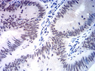 Figure 9:Immunohistochemical analysis of paraffin-embedded rectum cancer tissues using MSH2 mouse mAb with DAB staining.