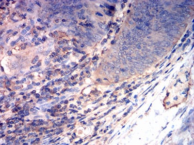 Figure 5:Immunohistochemical analysis of paraffin-embedded rectum cancer tissues using CD163 mouse mAb with DAB staining.