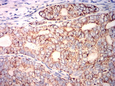Figure 5:Immunohistochemical analysis of paraffin-embedded cervical cancer tissues using PLA2G7 mouse mAb with DAB staining.