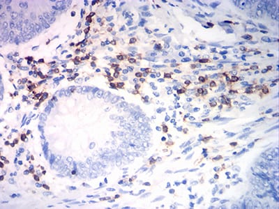 Figure 5:Immunohistochemical analysis of paraffin-embedded rectum cancer tissues using CD7 mouse mAb with DAB staining.