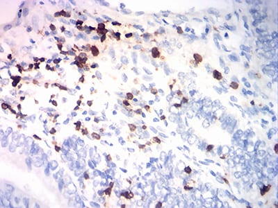 Figure 6:Immunohistochemical analysis of paraffin-embedded endometrial cancer tissues using CD7 mouse mAb with DAB staining.