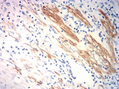 Figure 5:Immunohistochemical analysis of paraffin-embedded esophageal cancer tissues using ACTA2 mouse mAb with DAB staining.