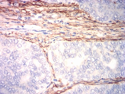 Figure 5:Immunohistochemical analysis of paraffin-embedded cervical cancer tissues using ACTA2 mouse mAb with DAB staining.