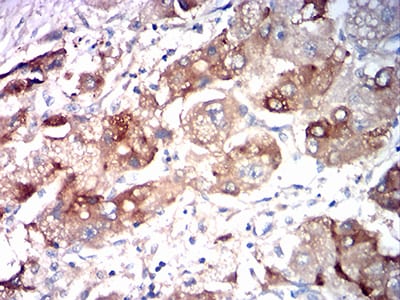Figure 5:Immunohistochemical analysis of paraffin-embedded liver cancer tissues using ASGR2 mouse mAb with DAB staining.