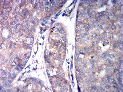 Figure 6:Immunohistochemical analysis of paraffin-embedded bladder cancer tissues using ASGR2 mouse mAb with DAB staining.