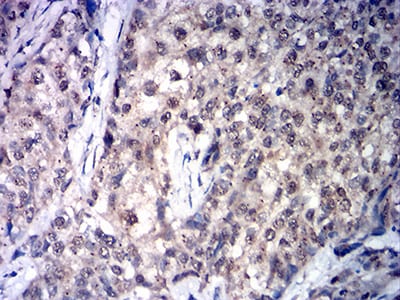 Figure 5:Immunohistochemical analysis of paraffin-embedded cervical cancer tissues using SDHB mouse mAb with DAB staining.