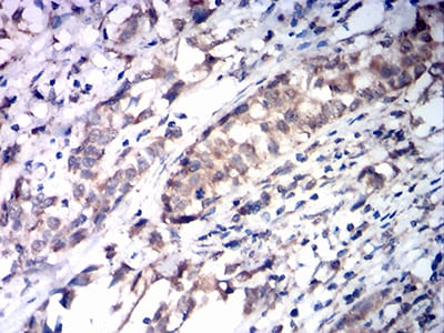 Figure 5:Immunohistochemical analysis of paraffin-embedded cervical cancer tissues using SDHB mouse mAb with DAB staining.