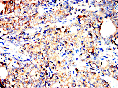 Figure 8:Immunohistochemical analysis of paraffin-embedded cervical carcinoma tissues using P4HB mouse mAb with DAB staining.