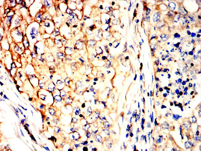 Figure 7:Immunohistochemical analysis of paraffin-embedded lung cancer tissues using P4HB mouse mAb with DAB staining.