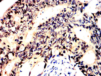 Figure 9:Immunohistochemical analysis of paraffin-embedded rectal cancer tissues using HSP70 mouse mAb with DAB staining.