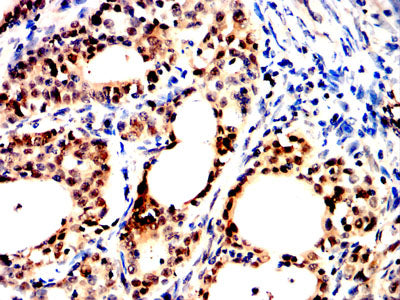 Figure 8:Immunohistochemical analysis of paraffin-embedded bladder cancer tissues using HSP70 mouse mAb with DAB staining.