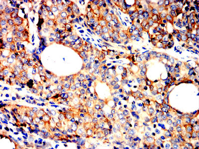 Figure 7:Immunohistochemical analysis of paraffin-embedded Cervical cancer tissues using AHNAK mouse mAb with DAB staining.