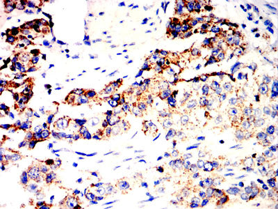 Figure 8:Immunohistochemical analysis of paraffin-embedded esophageal cancer tissues using SOCS3 mouse mAb with DAB staining.