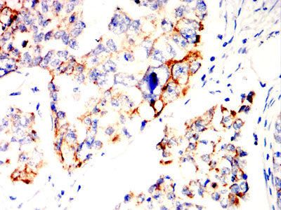 Figure 7:Immunohistochemical analysis of paraffin-embedded ovarian cancer tissues using SOCS3 mouse mAb with DAB staining.