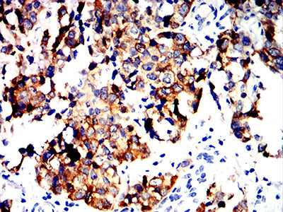 Figure 7:Immunohistochemical analysis of paraffin-embedded bladder cancer tissues using ALDH1L1 mouse mAb with DAB staining.