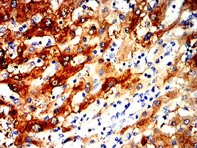 Figure 6:Immunohistochemical analysis of paraffin-embedded liver cancer tissues using ALDH1L1 mouse mAb with DAB staining.