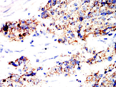 Figure 7:Immunohistochemical analysis of paraffin-embedded esophageal cancer tissues using SOCS3 mouse mAb with DAB staining.