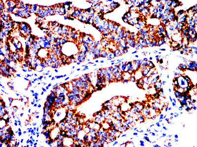 Figure 9:Immunohistochemical analysis of paraffin-embedded rectal cancer tissues using HSPA9 mouse mAb with DAB staining.