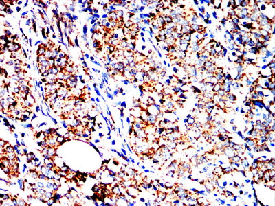 Figure 8:Immunohistochemical analysis of paraffin-embedded cervical carcinoma tissues using HSPA9 mouse mAb with DAB staining.