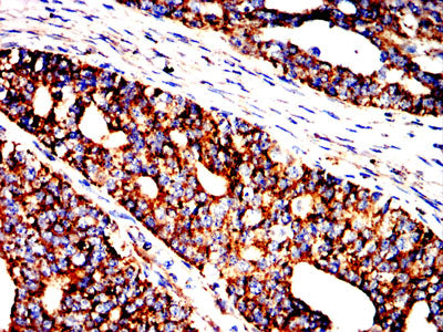 Figure 9:Immunohistochemical analysis of paraffin-embedded ovarian cancer tissues using HSPA9 mouse mAb with DAB staining.