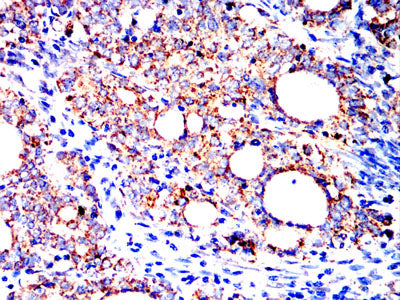 Figure 8:Immunohistochemical analysis of paraffin-embedded cervical carcinoma tissues using HSPA9 mouse mAb with DAB staining.