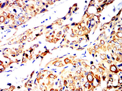 Figure 7:Immunohistochemical analysis of paraffin-embedded esophageal cancer tissues using NDC80 mouse mAb with DAB staining.