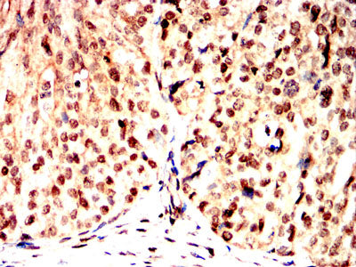 Figure 7:Immunohistochemical analysis of paraffin-embedded mammary cancer tissues using GMNN mouse mAb with DAB staining.