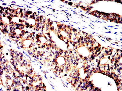 Figure 6:Immunohistochemical analysis of paraffin-embedded ovarian cancer tissues using GMNN mouse mAb with DAB staining.