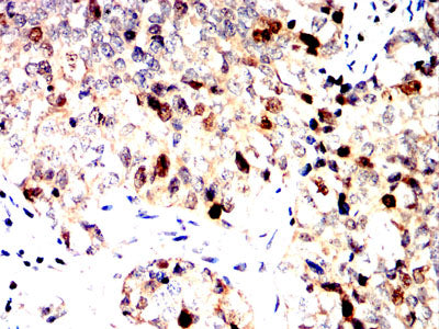 Figure 6:Immunohistochemical analysis of paraffin-embedded bladder cancer tissues using GMNN mouse mAb with DAB staining.