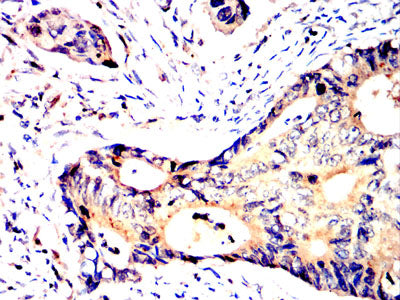 Figure 7:Immunohistochemical analysis of paraffin-embedded rectal cancer tissues using SV2C mouse mAb with DAB staining.